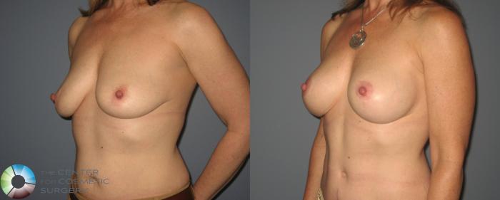 Before & After Breast Augmentation Case 414 View #2 View in Golden, CO
