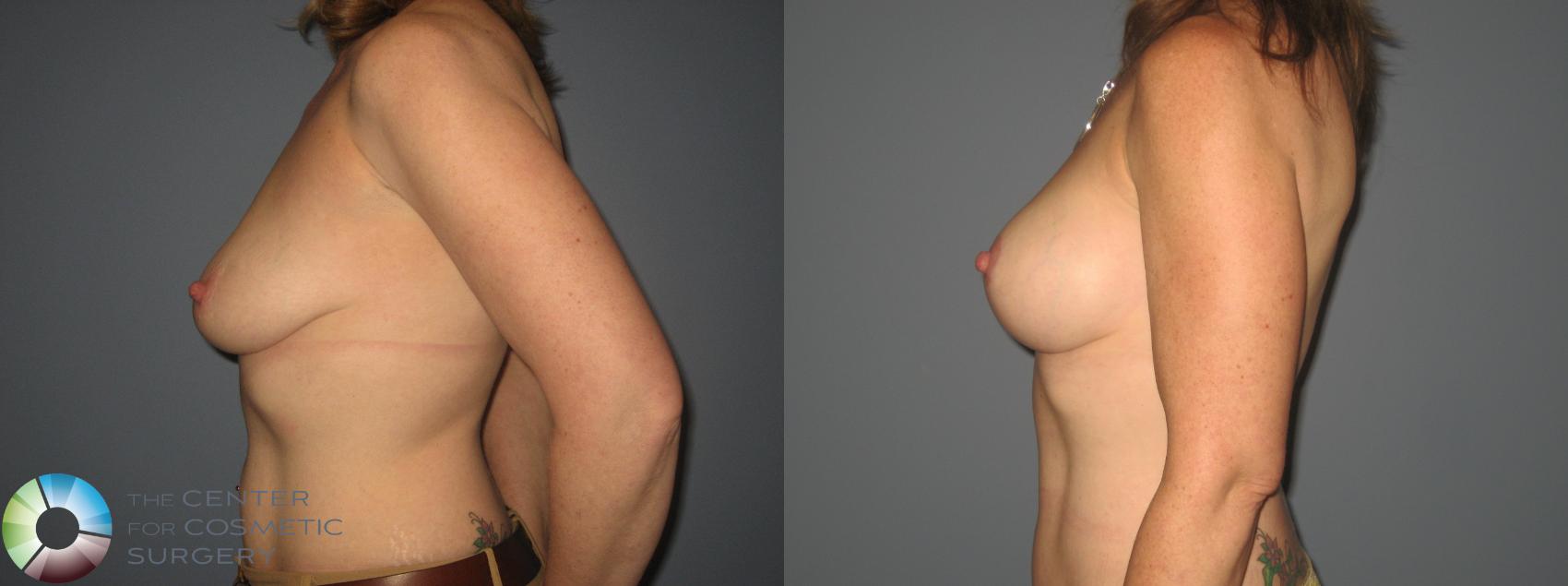 Before & After Breast Augmentation Case 414 View #3 in Denver and Colorado Springs, CO