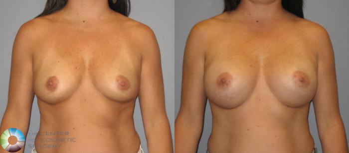 Before & After Breast Augmentation Case 419 View #1 in Denver, CO