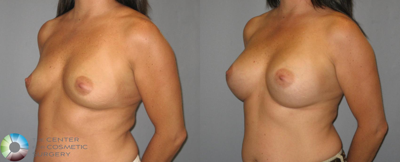 Before & After Breast Augmentation Case 419 View #2 View in Golden, CO