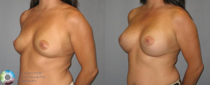Before & After Breast Augmentation Case 419 View #2 in Denver, CO