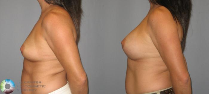 Before & After Breast Augmentation Case 419 View #3 in Denver, CO
