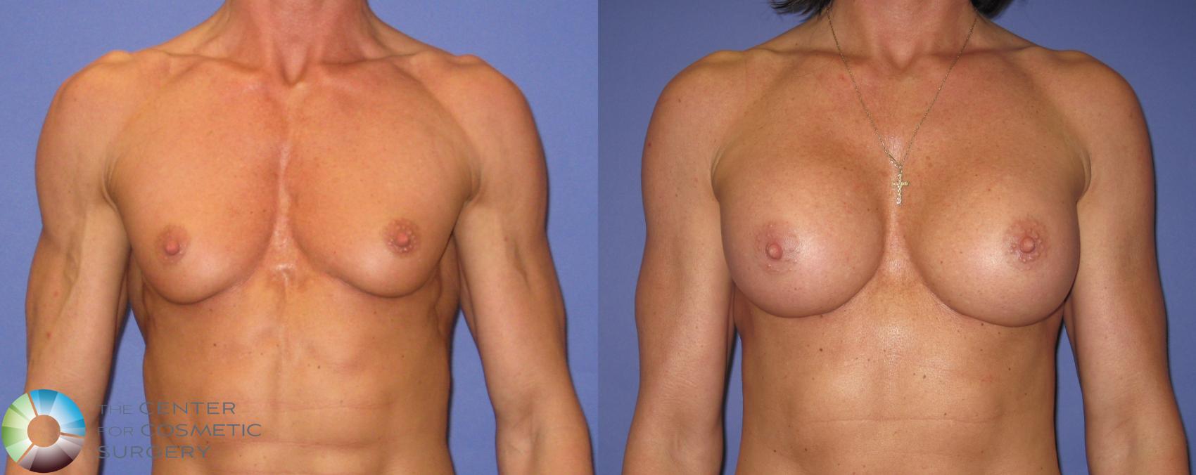 Before & After Breast Augmentation Case 421 View #1 in Denver and Colorado Springs, CO