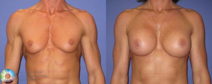 Before & After Breast Augmentation Case 421 View #1 in Denver and Colorado Springs, CO