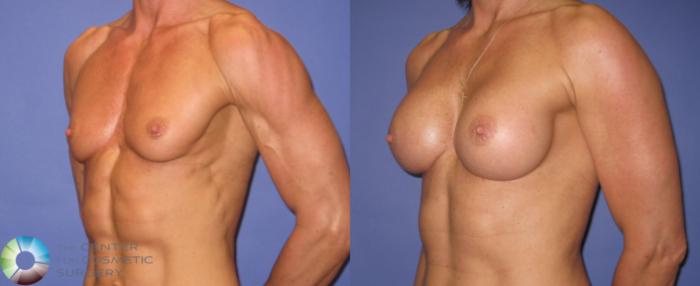 Before & After Breast Augmentation Case 421 View #2 in Denver and Colorado Springs, CO