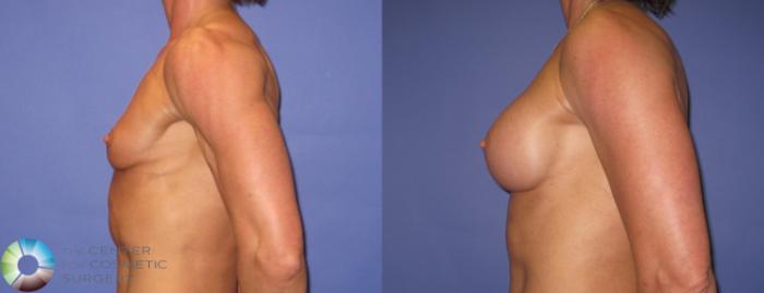 Before & After Breast Augmentation Case 421 View #3 in Denver and Colorado Springs, CO