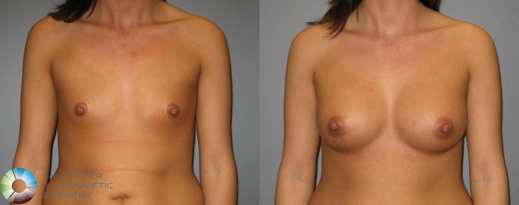 Before & After Breast Augmentation Case 422 View #1 in Denver and Colorado Springs, CO