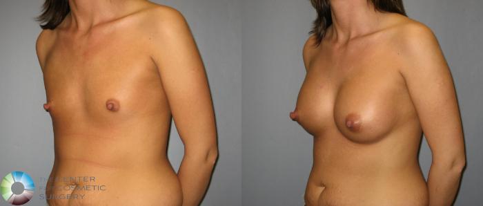 Before & After Breast Augmentation Case 422 View #2 in Denver and Colorado Springs, CO