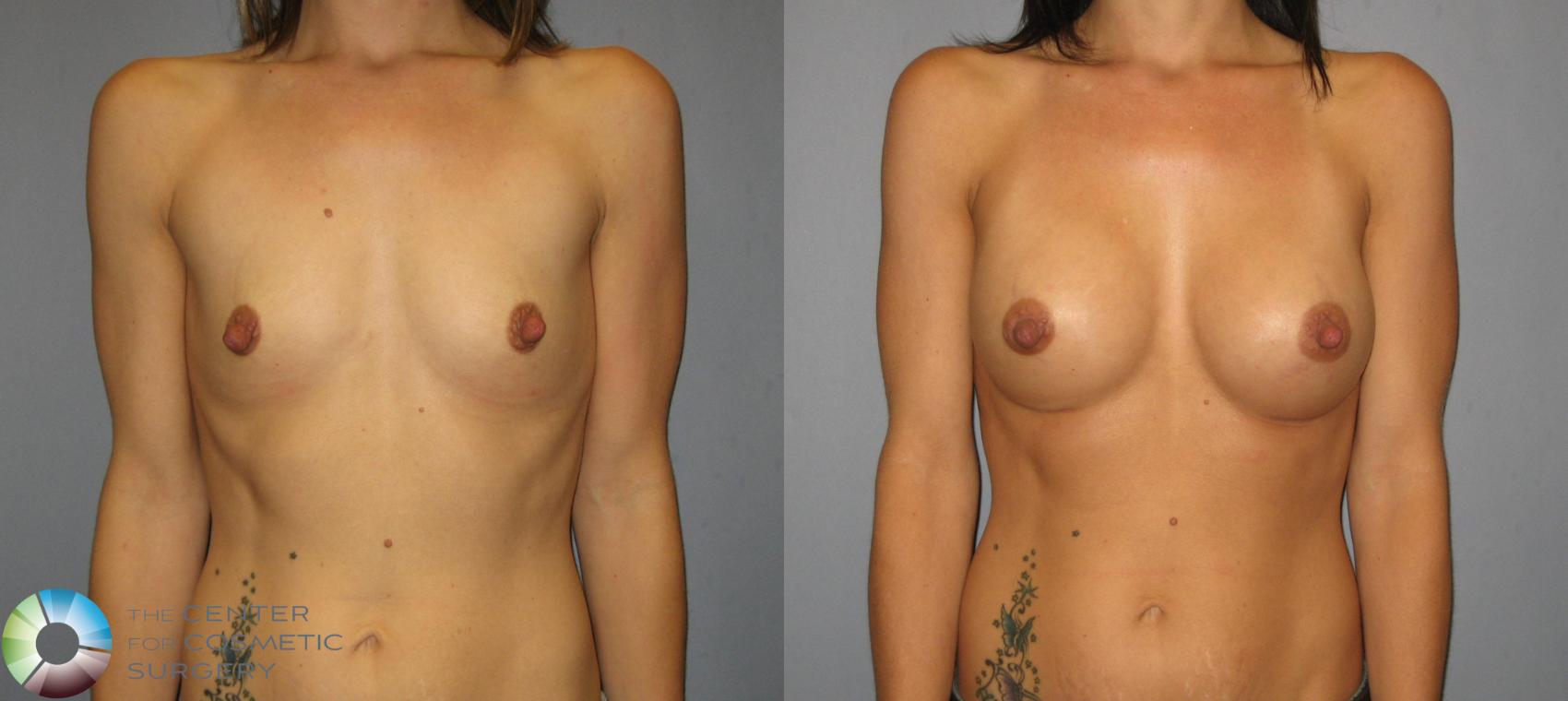 Before & After Breast Augmentation Case 423 View #1 in Denver and Colorado Springs, CO