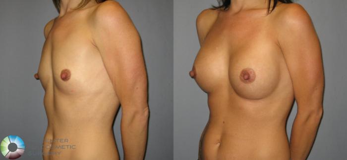 Before & After Breast Augmentation Case 423 View #2 in Denver and Colorado Springs, CO
