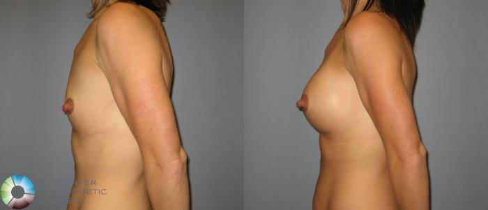 Before & After Breast Augmentation Case 423 View #3 in Denver and Colorado Springs, CO