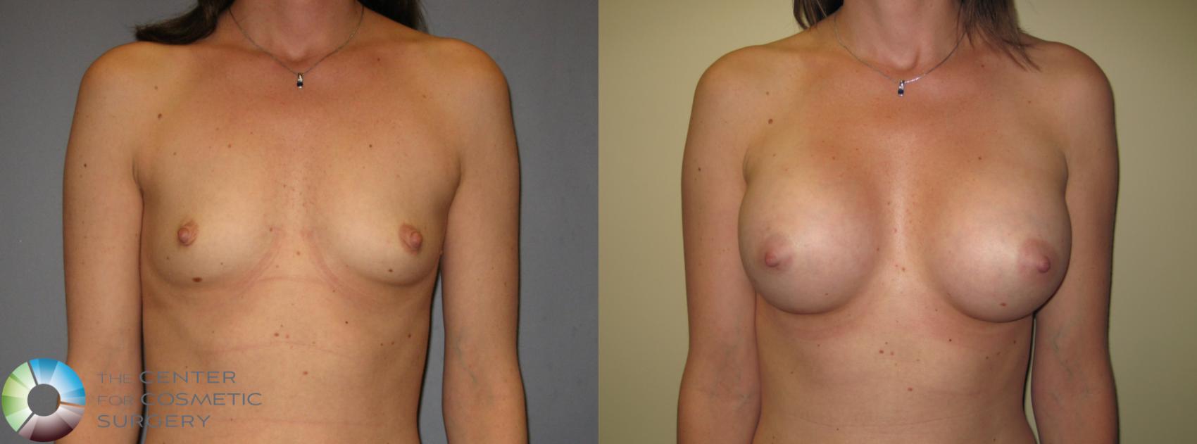 Before & After Breast Augmentation Case 424 View #1 in Denver and Colorado Springs, CO