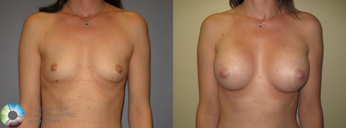 Before & After Breast Augmentation Case 424 View #1 View in Golden, CO