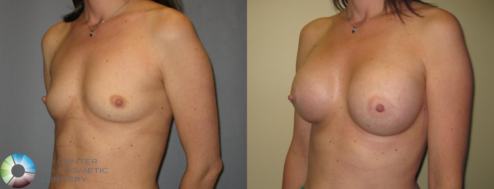 Before & After Breast Augmentation Case 424 View #2 in Denver and Colorado Springs, CO