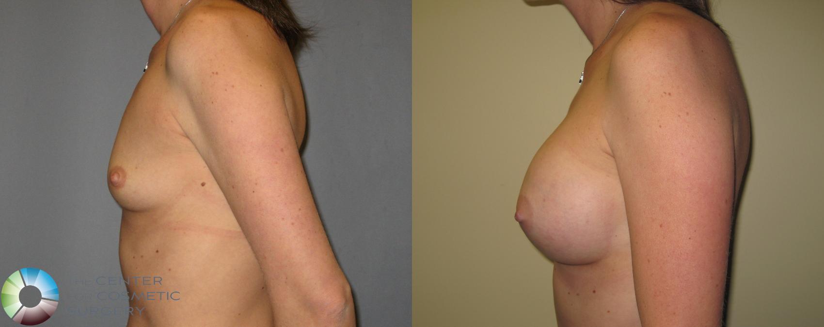 Before & After Breast Augmentation Case 424 View #3 in Denver and Colorado Springs, CO