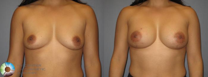 Before & After Breast Augmentation Case 427 View #1 in Denver and Colorado Springs, CO