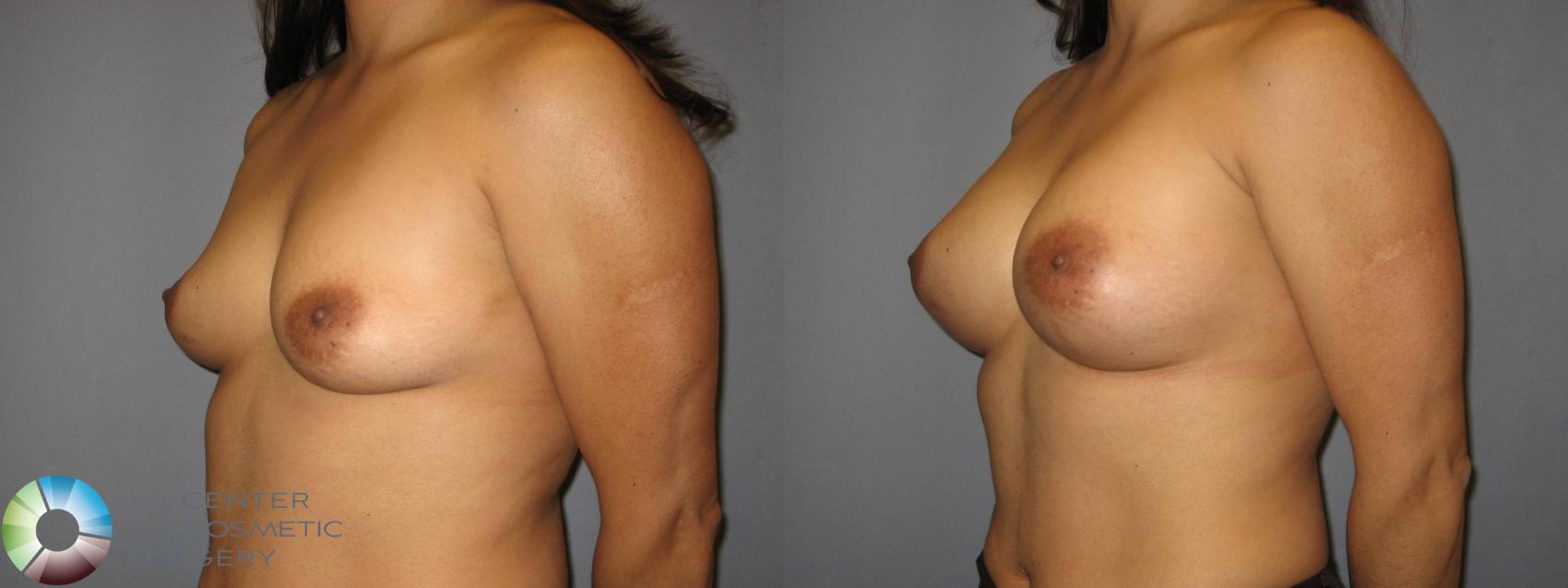 Before & After Breast Augmentation Case 427 View #2 View in Golden, CO