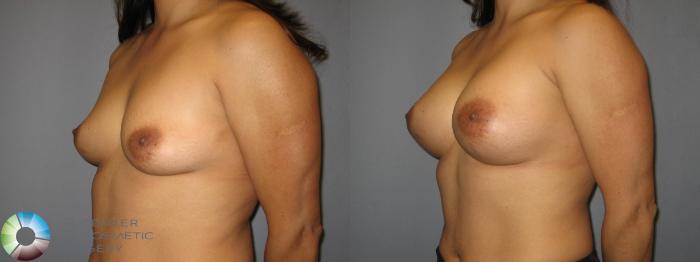 Before & After Breast Augmentation Case 427 View #2 in Denver and Colorado Springs, CO