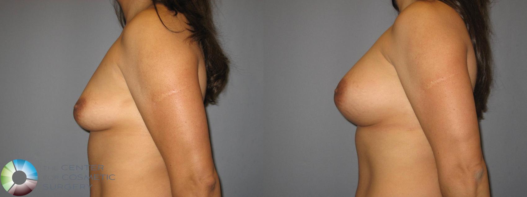 Before & After Breast Augmentation Case 427 View #3 View in Golden, CO