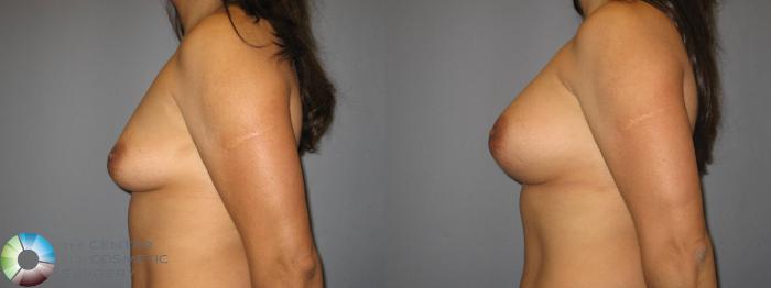 Before & After Breast Augmentation Case 427 View #3 in Denver and Colorado Springs, CO