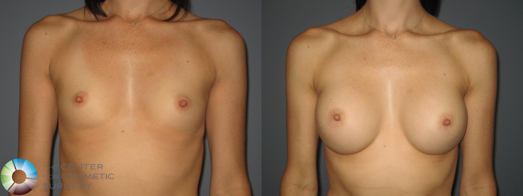 Before & After Breast Augmentation Case 434 View #1 in Denver and Colorado Springs, CO