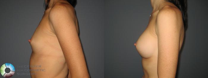 Before & After Breast Augmentation Case 434 View #3 View in Golden, CO