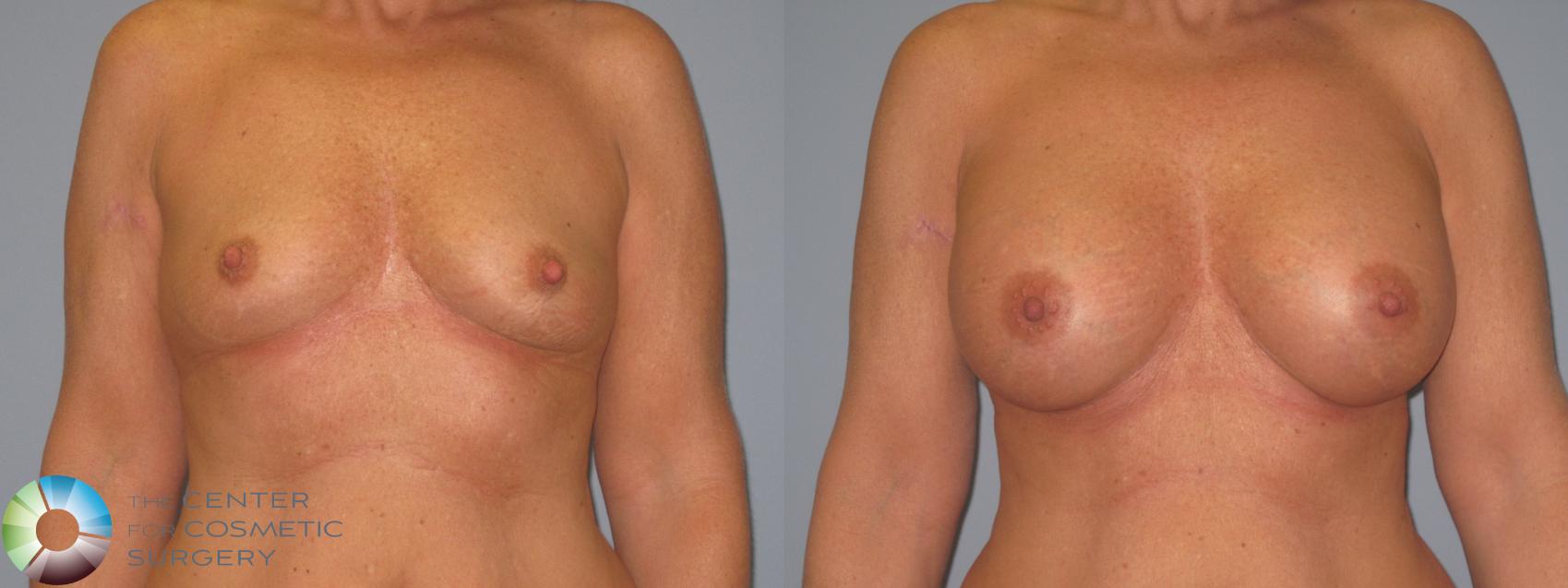 Before & After Breast Augmentation Case 454 View #1 in Denver and Colorado Springs, CO