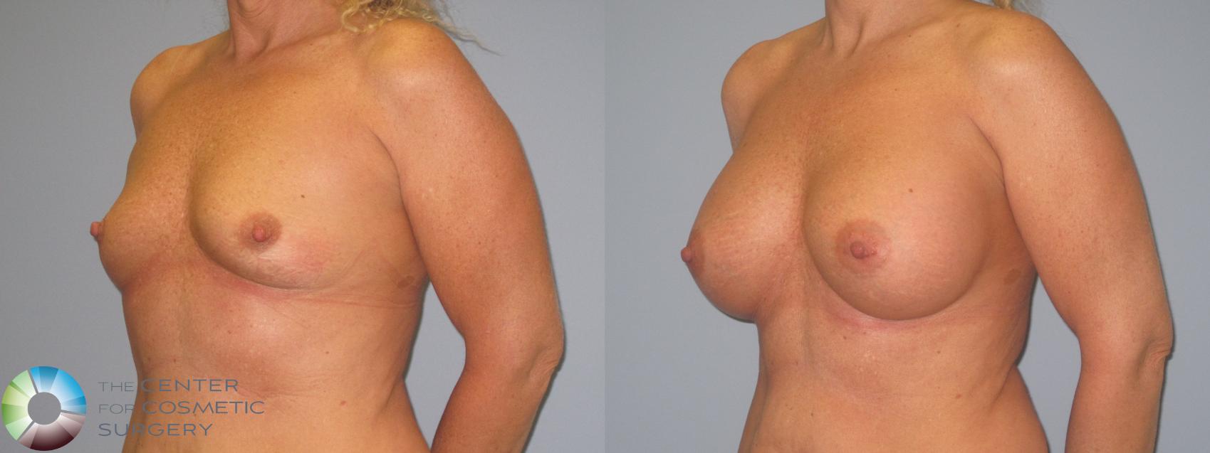 Before & After Breast Augmentation Case 454 View #2 View in Golden, CO