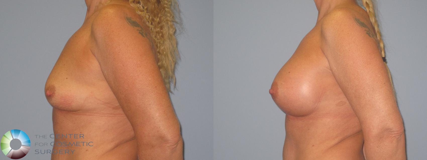 Before & After Breast Augmentation Case 454 View #3 View in Golden, CO