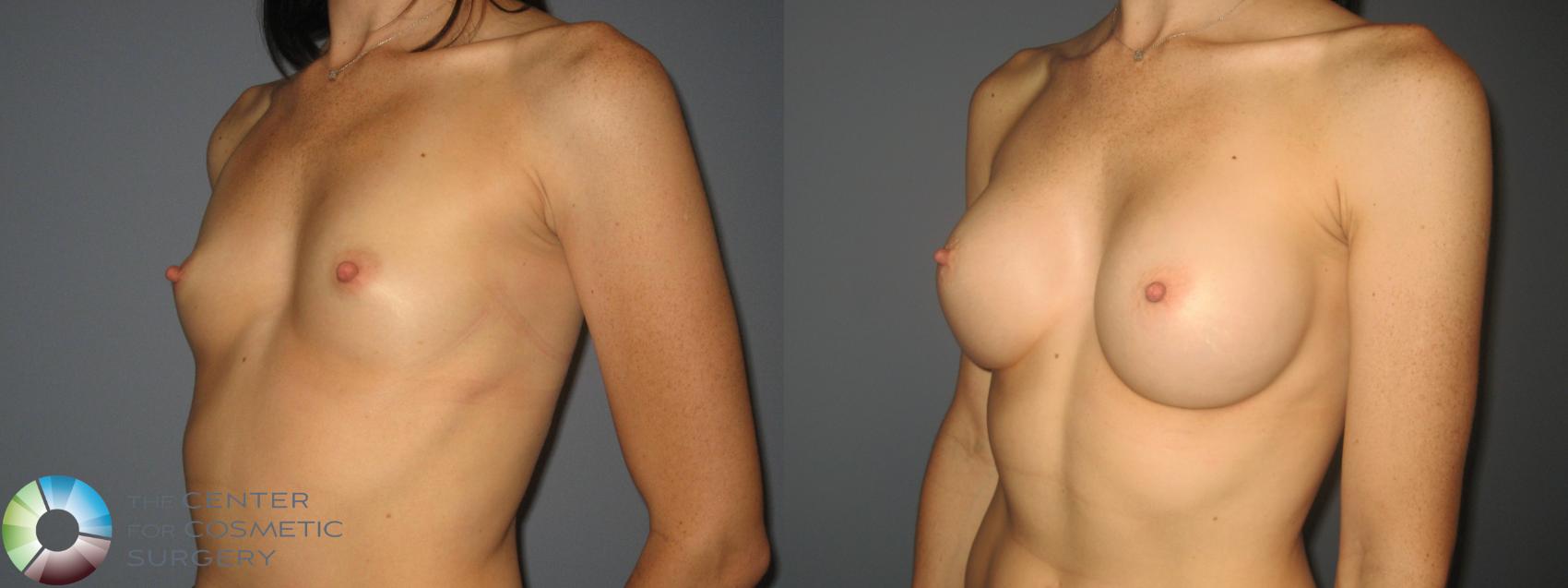 Before & After Breast Augmentation Case 458 View #2 in Denver and Colorado Springs, CO
