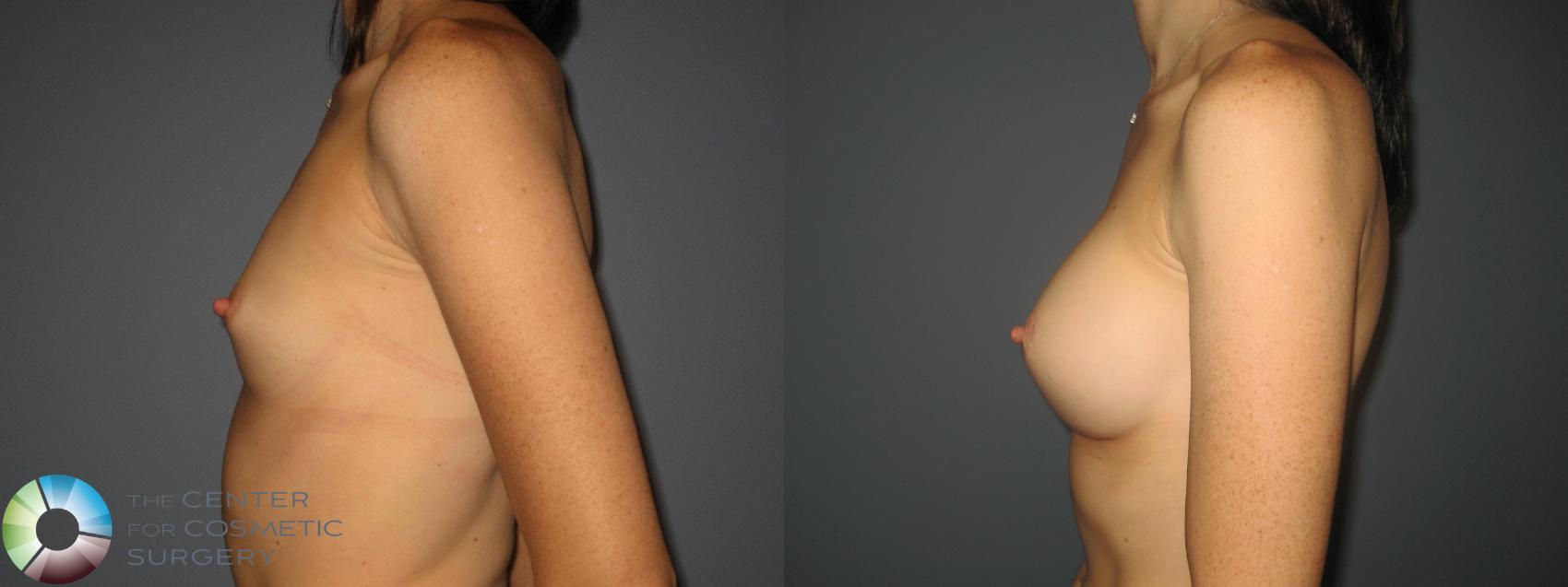 Before & After Breast Augmentation Case 458 View #3 in Denver and Colorado Springs, CO
