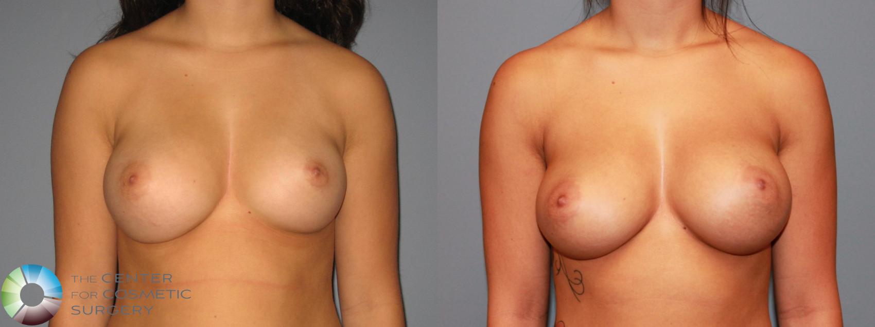 Before & After Breast Augmentation Case 466 View #1 in Denver, CO