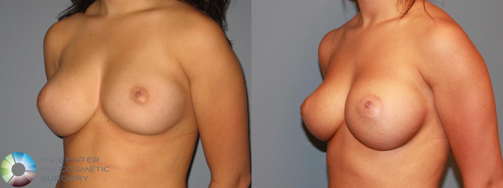 Before & After Breast Augmentation Case 466 View #2 in Denver and Colorado Springs, CO