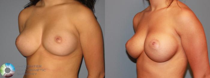 Before & After Breast Augmentation Case 466 View #2 View in Golden, CO
