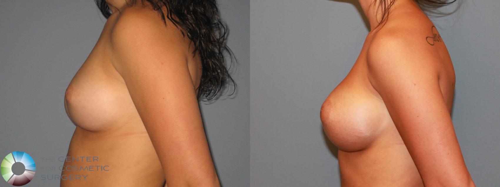 Before & After Breast Augmentation Case 466 View #3 in Denver and Colorado Springs, CO