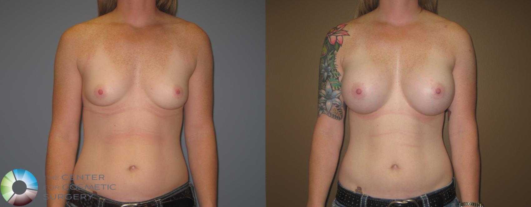 Before & After Breast Augmentation Case 468 View #1 in Denver and Colorado Springs, CO