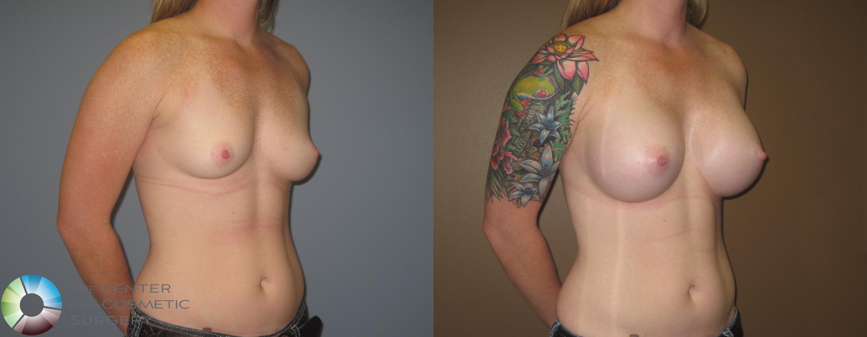 Before & After Breast Augmentation Case 468 View #2 View in Denver & Golden, CO