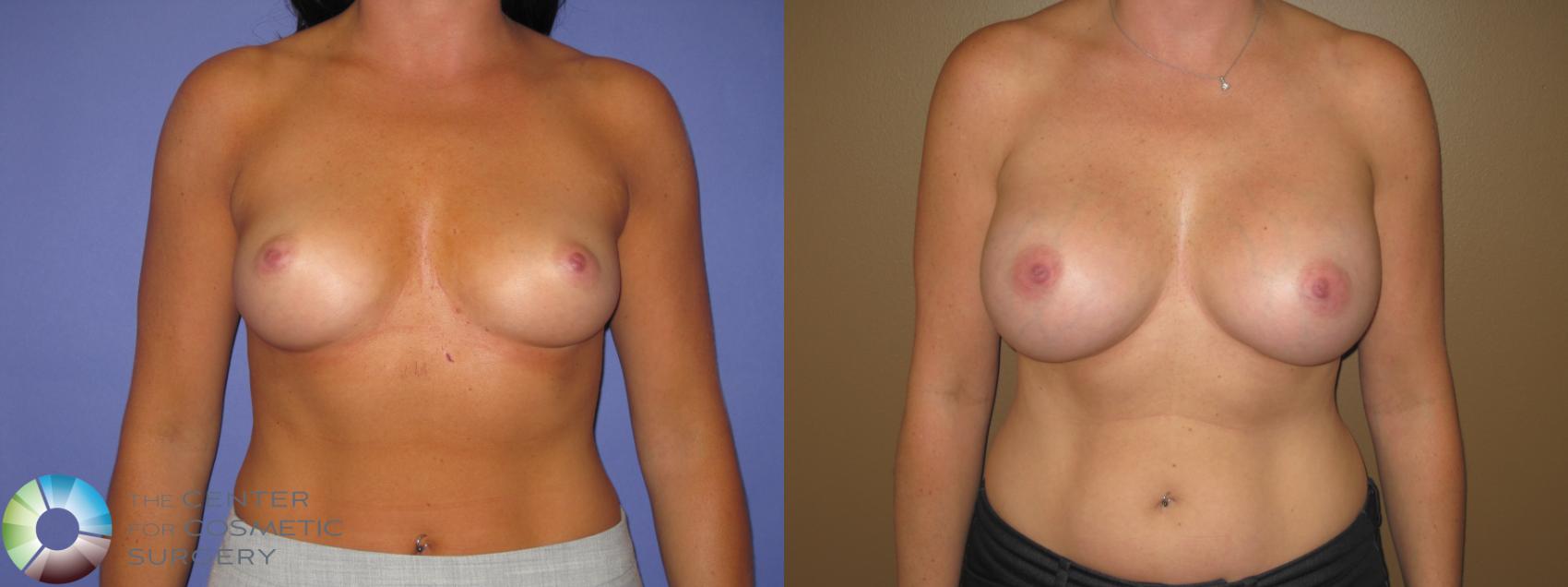 Before & After Breast Augmentation Case 469 View #1 in Denver and Colorado Springs, CO