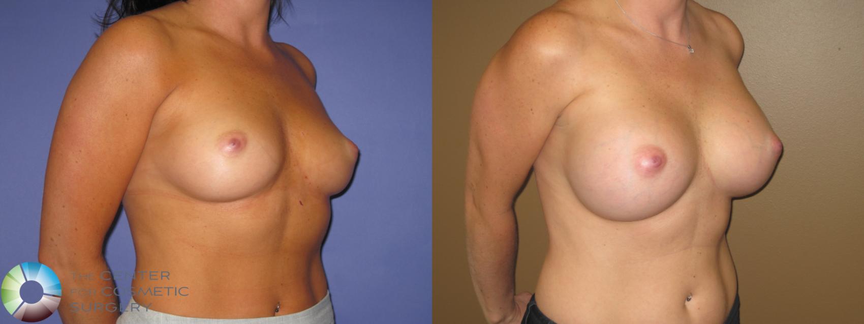 Before & After Breast Augmentation Case 469 View #2 in Denver and Colorado Springs, CO