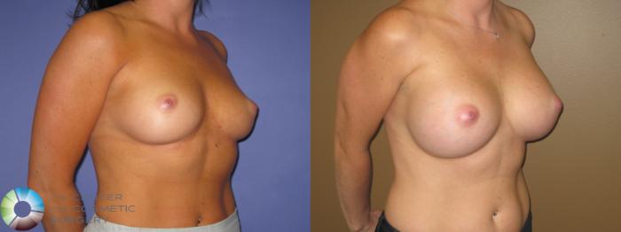 Before & After Breast Augmentation Case 469 View #2 View in Golden, CO