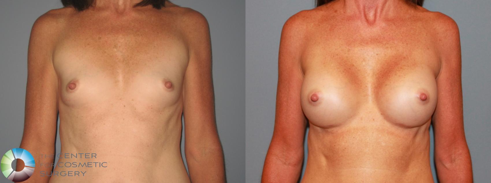 Before & After Breast Augmentation Case 471 View #1 in Denver and Colorado Springs, CO