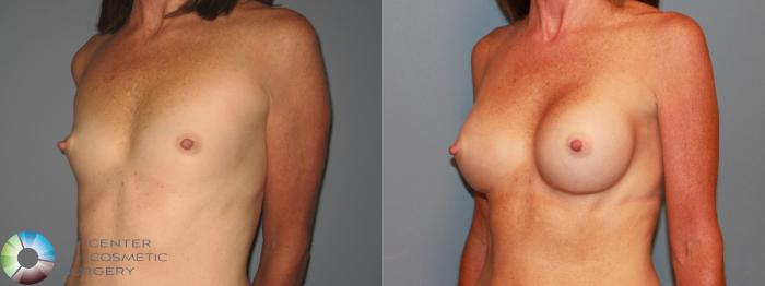 Before & After Breast Augmentation Case 471 View #2 View in Golden, CO