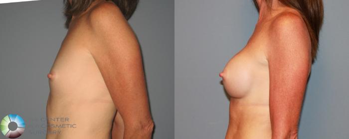 Before & After Breast Augmentation Case 471 View #3 View in Golden, CO