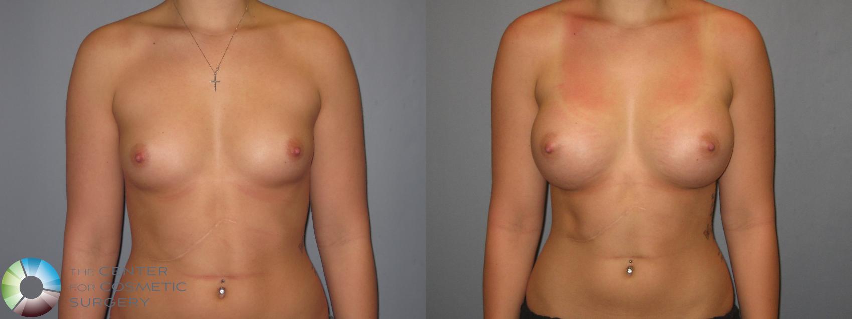 Before & After Breast Augmentation Case 473 View #1 in Denver and Colorado Springs, CO