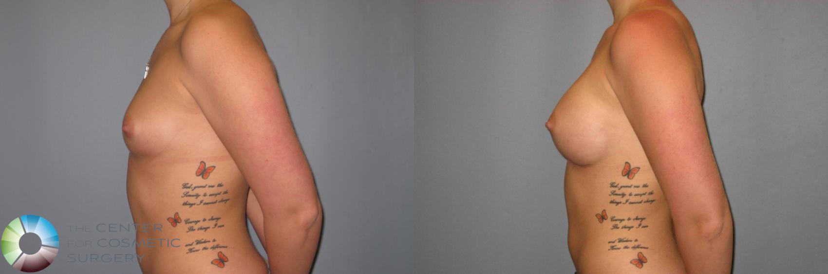 Before & After Breast Augmentation Case 473 View #2 View in Golden, CO