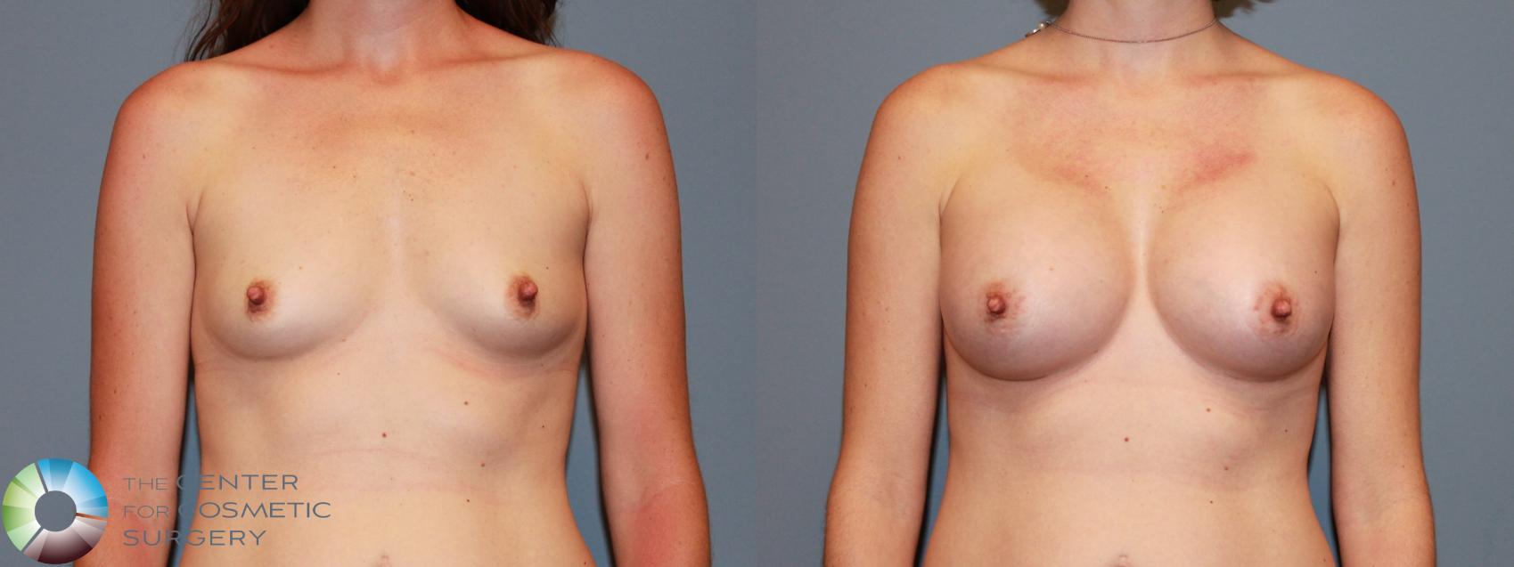 Before & After Breast Augmentation Case 478 View #1 in Denver and Colorado Springs, CO