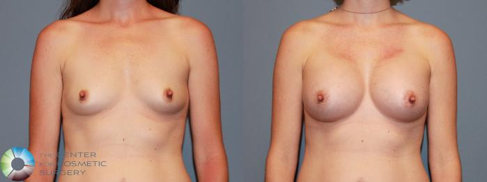 Before & After Breast Augmentation Case 478 View #1 View in Golden, CO