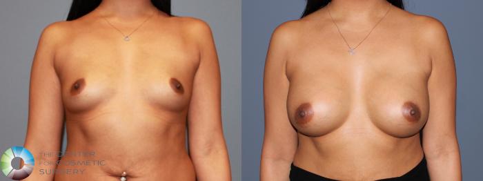 Before & After Breast Augmentation Case 479 View #1 View in Golden, CO