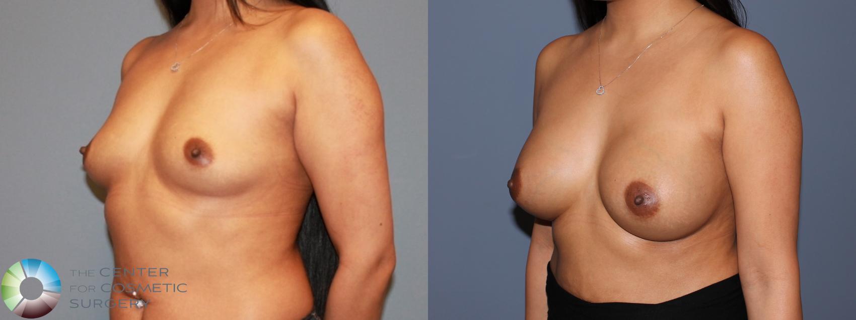 Before & After Breast Augmentation Case 479 View #2 in Denver and Colorado Springs, CO
