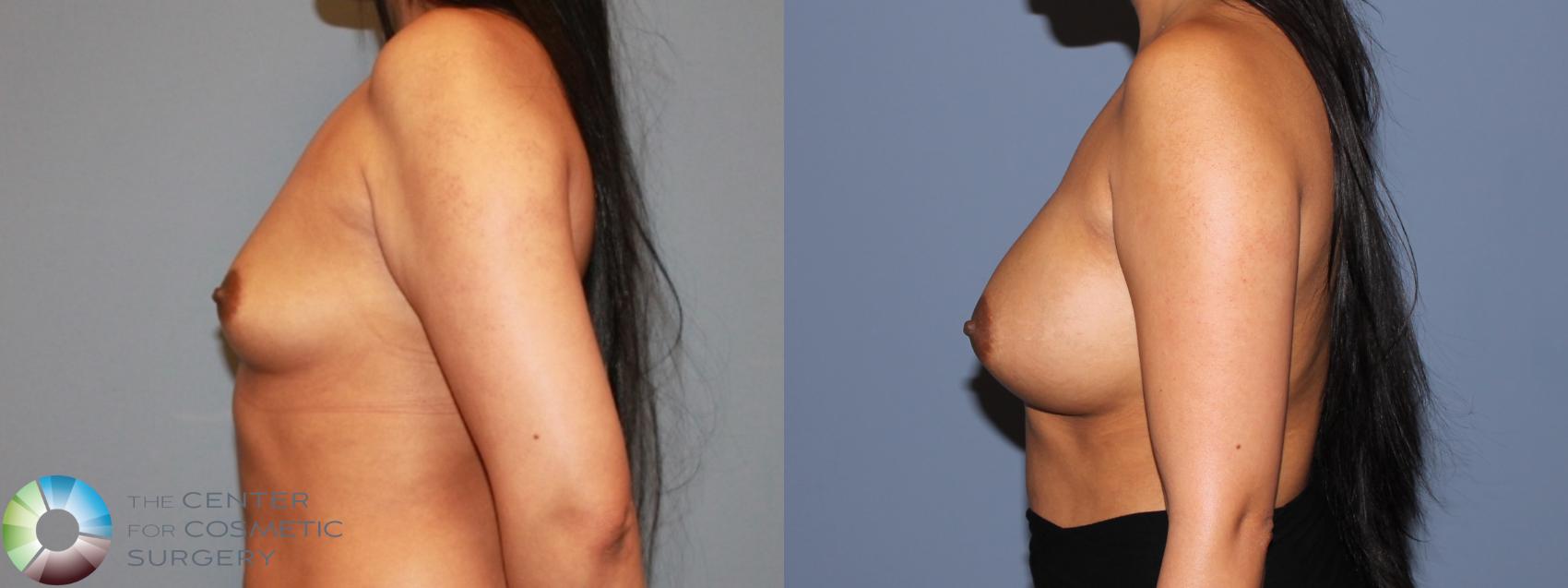 Before & After Breast Augmentation Case 479 View #3 in Denver and Colorado Springs, CO